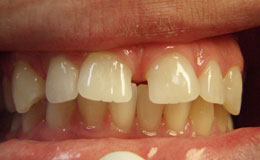 Misaligned teeth before cosmetic dentistry