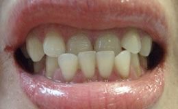 Patient with underbite before orthodontic treatment