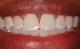 Brilliant white smile after cosmetic dentistry