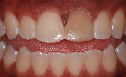 Discolored smile before cosmetic dentistry