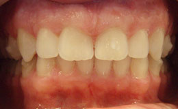 Flawlessly aligned smile after cosmetic dentistry