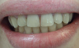 Patient with corrected bite after orthodontic treatment