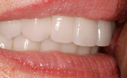Bright healthy smile after teeth whitening