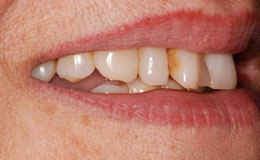 Discolored and yellowed smile before teeth whitening