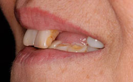 Smile with missing top teeth before tooth replacement