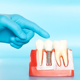 Vienna implant dentist points to model of dental implants