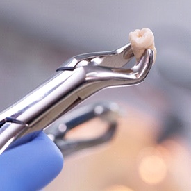 extracted tooth held by a dental instrument